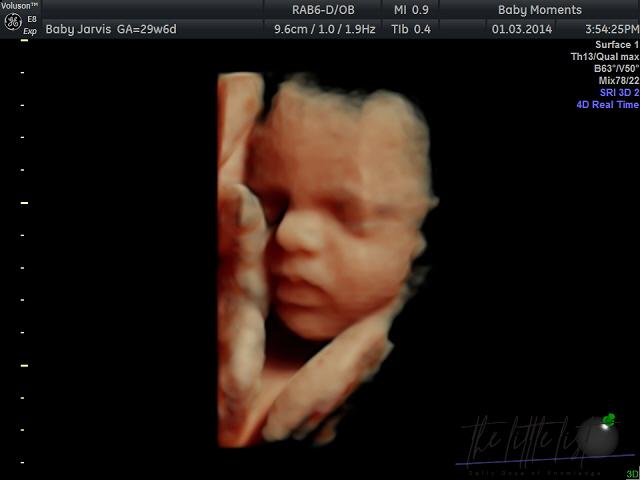 Can you detect twins at 4 weeks?
